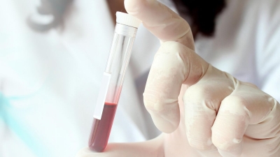 Analiza gjaku të cilat diktojnë kancerin që përpara simptomave