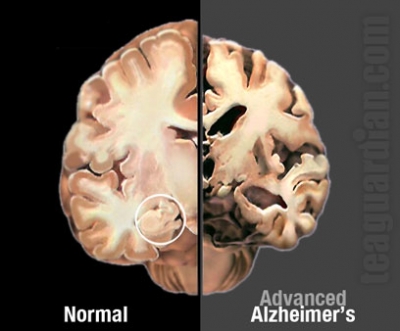 Gjithçka duhet të dini mbi sëmundjen e Alzheimer-it