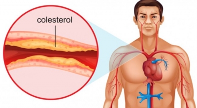 Rreziku dhe lidhjet e kolesterolit të lartë me sëmundjet e tjera