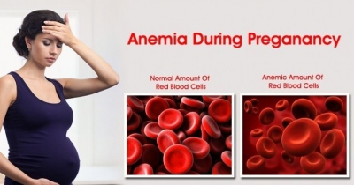 Anemia në shtatzëni, efektet negative te fëmija