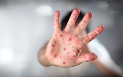 Maqedoni e Veriut, regjistrohet viktima e katërt e fruthit