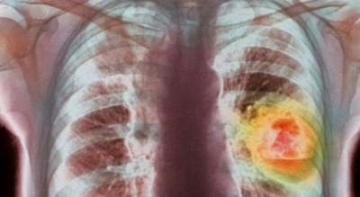 Ndotja e ajrit, faktor risku për kancerin në mushkëri
