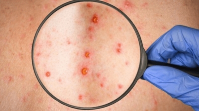 OBSH në alarm: Rikthehet fruthi në 4 shetete europiane, mes tyre dhe Shqipëria