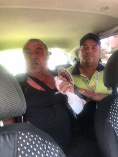 FOTO/ “Më goditën me radio e grushte”, 61-vjeçari denoncon dhunën e patrullës së policisë: Më thyen krahun