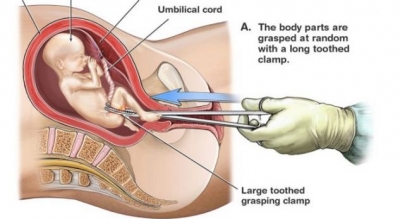 Çfarë ndodh me foshnjën gjatë abortit? Video që ka prekur zemrat e shumë njerëzve